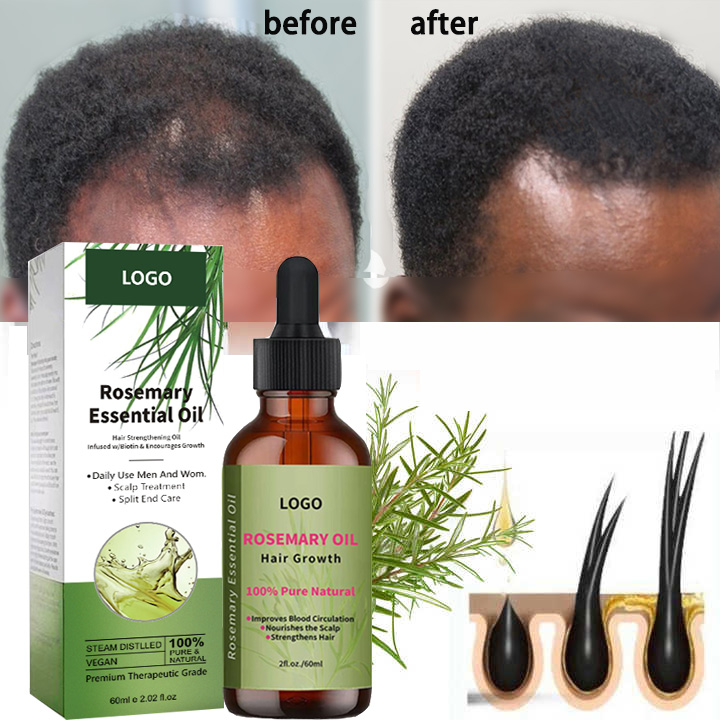 L’huile essentielle de romarin est-elle utilisée pour faire pousser les cheveux et réduire leur chute ? L'effet est meilleur que.....